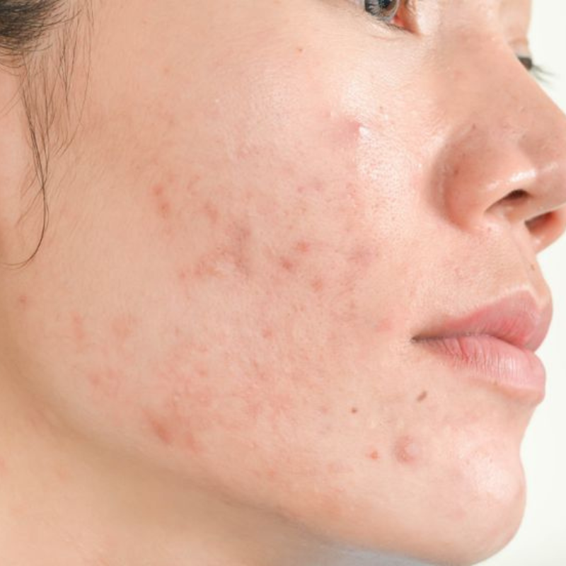 Serum trị mụn, giảm thâm, giảm tàng nhan