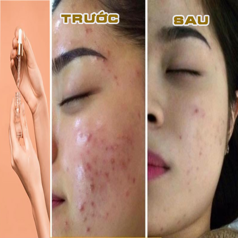 Công dụng của serum trị mụn Hàn Quốc trước và sau khi sử dụng